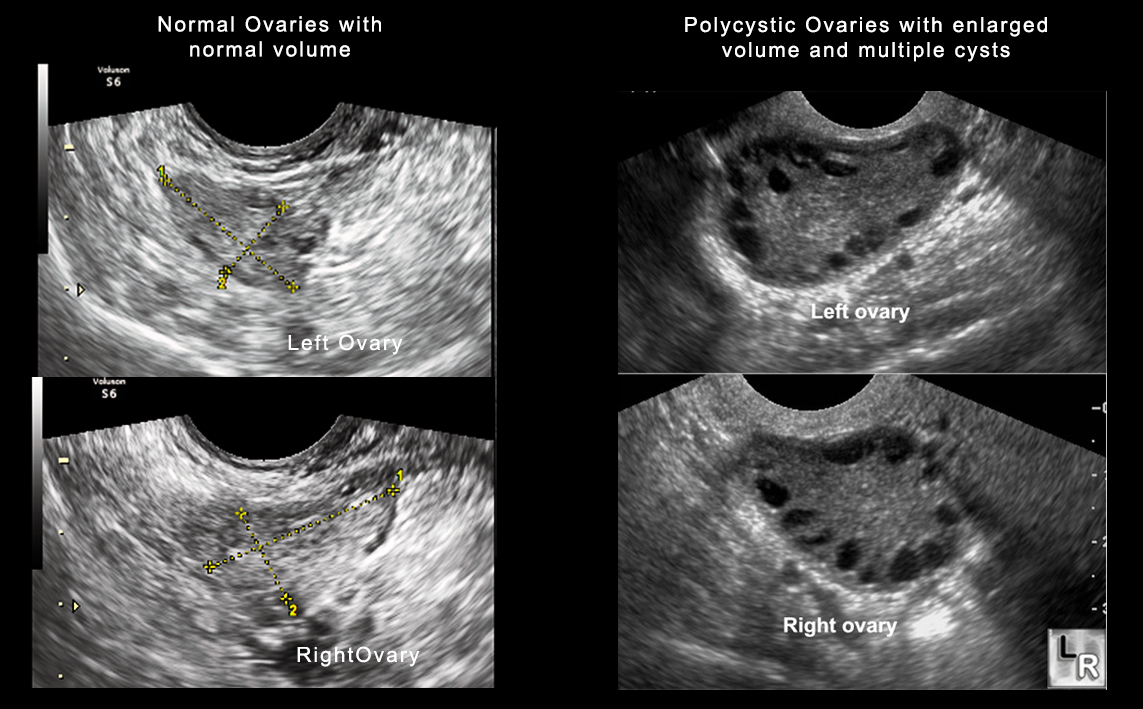 Sindrome dell'ovaio policistico: reperto ecografico